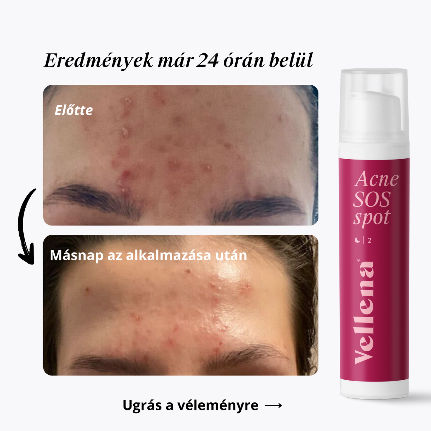 Pattanáskezelő Gél 15ml | Vellena